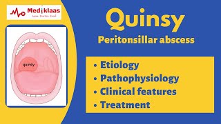 Quinsy  Peritonsillar abscess  Etiology clinical features treatment Mediklaas [upl. by Aniram659]