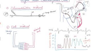 Right Heart Catheterization [upl. by Hilda]