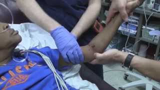 Posterior Elbow Dislocation Reduction [upl. by Lashonde]