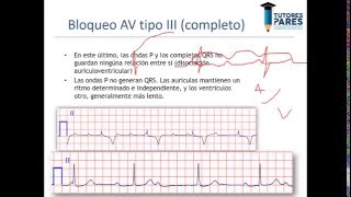 Arritmias en el electrocardiograma [upl. by Anyaled]