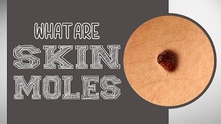 What are Skin Moles [upl. by Milty50]