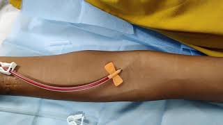 Intravenous cannulation tips and tricks [upl. by Turley]