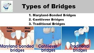 Types Of Dental Bridges [upl. by Olihs]