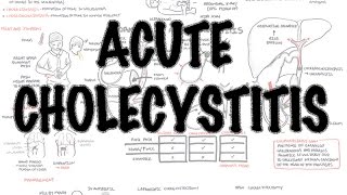 Acute Cholecystitis Imaging  Effervescent Gallbladder [upl. by Anawait]