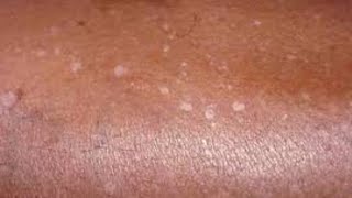 HOW TO TREAT WHITE PATCHES  CAUSES [upl. by Atnom]