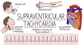 Wide complex tachycardia  Part 1 [upl. by Arvad]