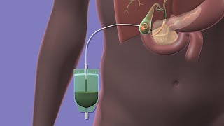 Acute Cholecystitis and Cholangitis [upl. by Edina535]