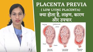 Placenta Previa FAQs By Dr Richa Vaishnav [upl. by Drofkcor]