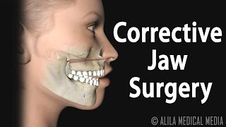 Corrective Jaw Orthognathic Surgery Animation [upl. by Estren]