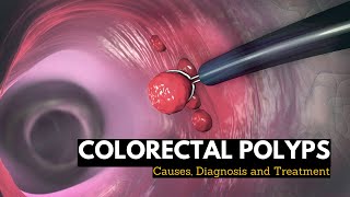 Colorectal Polyps Causes Signs and Symptoms Diagnosis and Treatment [upl. by Dessma757]