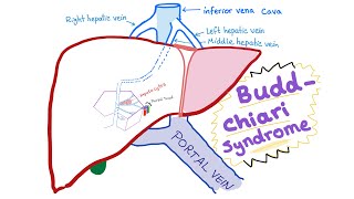 3 Causes of Polycystic Ovarian Syndrome PCOS amp High Androgens – Dr Berg [upl. by Rhyner]