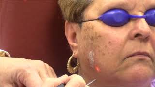 Dr Bruce Katz Treats Sun Spots with the Alexandrite Laser [upl. by Sajovich767]