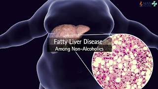 Diagnosing liver disease with Fibroscan technology [upl. by Bellda]