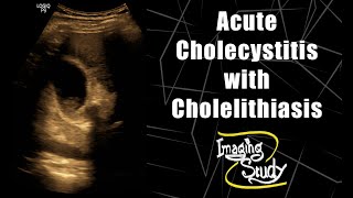 Gallstones and Cholecystitis  Signs Symptoms And Treatment [upl. by Eseilenna]