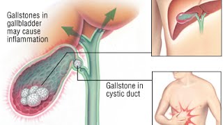 Cholecystitis [upl. by Alarick]