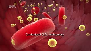 Arteriosclerosis [upl. by Wilinski]