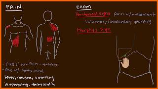 Acute Cholecystitis 23 [upl. by Dehnel]