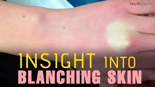 Blanching Skin  Causes Symptoms and Treatment [upl. by Lacagnia834]