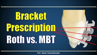 Using Roth and MBT brackets [upl. by Raynah]