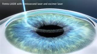 LASER Vision Correction Femto LASIK and PRK eye surgery for high myopia and astigmatism [upl. by Kobi76]