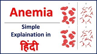 Anemia amp its types simple explaination in Hindi  Bhushan Science [upl. by Vinita]