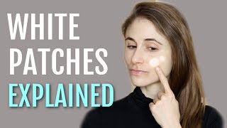 WHITE PATCHES ON THE FACE EXPLAINED PITYRIASIS ALBA DR DRAY [upl. by Zinn559]