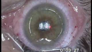 Femtosecond Laser Assisted Cataract Surgery [upl. by Ahsinawt]