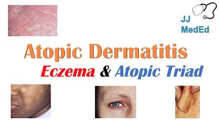 Eczema Atopic Dermatitis  Atopic Triad Triggers Who gets it Why does it happen amp Treatment [upl. by Ausoj]