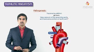 Syphilitic aneurysm  ascending aorta amp arch or aorta   Pathology Usmle step 1 Fmge and Neet Pg [upl. by Uke]