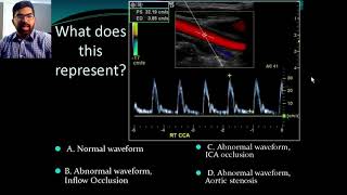 Carotid flow measurement video [upl. by Ahsiret983]