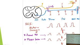 6 Quick Reviews EMG and Nerve Conduction Study [upl. by Collie]