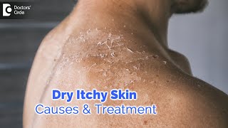 Dry itchy skin all over body Causes Diagnosis Treatment  Dr Rashmi Ravindra  Doctors Circle [upl. by Ahrendt199]