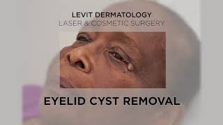 Eyelid Cyst Removal [upl. by Tad]