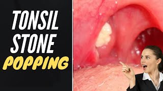 Tonsil Stone Removal  Popping Tonsil Stones [upl. by Romilda992]