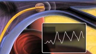 SwanGanz Thermodilution Pulmonary Artery Catheter [upl. by Adirahs]