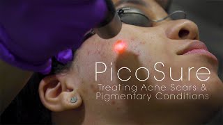 PicoSure Laser for Acne Scars amp Pigmentation [upl. by Ennyl]