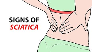 Signs of Sciatica [upl. by Alisen]