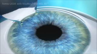 Laser Eye Surgery LASIK [upl. by Alyhc]