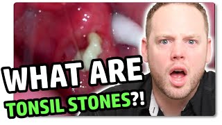 Tonsil Stones Explained In Under 3 Minutes [upl. by Annabelle]