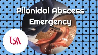 Pilonidal Abscess Emergency Incision amp Drainage [upl. by Leirud818]