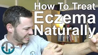 How To Treat Eczema Naturally [upl. by Madancy]