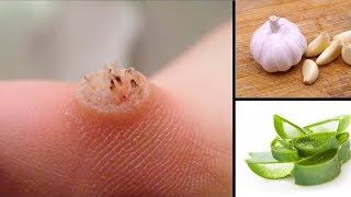 How To Remove Warts At Home Naturally [upl. by Hiett33]