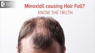 KNOW THE TRUTH  Does Minoxidil Solution cause Hair Fall Dr Deepak P Devakar  Doctors Circle [upl. by Friedman]