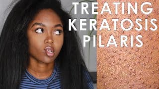 TREATING KERATOSIS PILARIS  3 EASY STEPS [upl. by Latnahc]