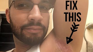 Fix ArmpitHeat Rash From Home [upl. by Amlet]