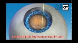 Femtosecond laser introduced new and more accurate methods to cataract surgery [upl. by Burke]