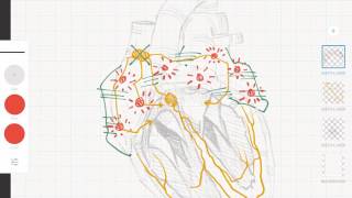 Cardiología y ECG Taquicardias supraventriculares vs ventriculares [upl. by Kreager703]